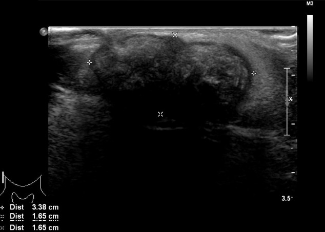 【佳学基因检测】巨大毛母质瘤的基因检测案例