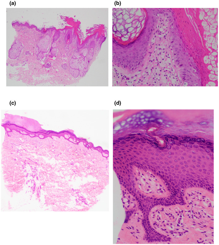 【佳学基因检测】CHILD综合征基因解码、基因检测有什么用？