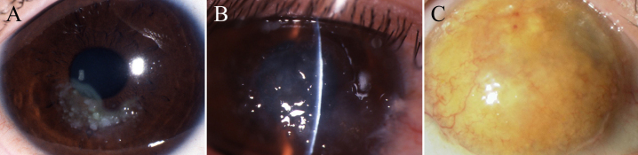 【佳学基因检测】怎样选择晶状体角膜营养不良Ⅲ型基因解码、基因检测？