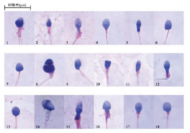 【佳学基因检测】畸形精子症基因解码、基因检测