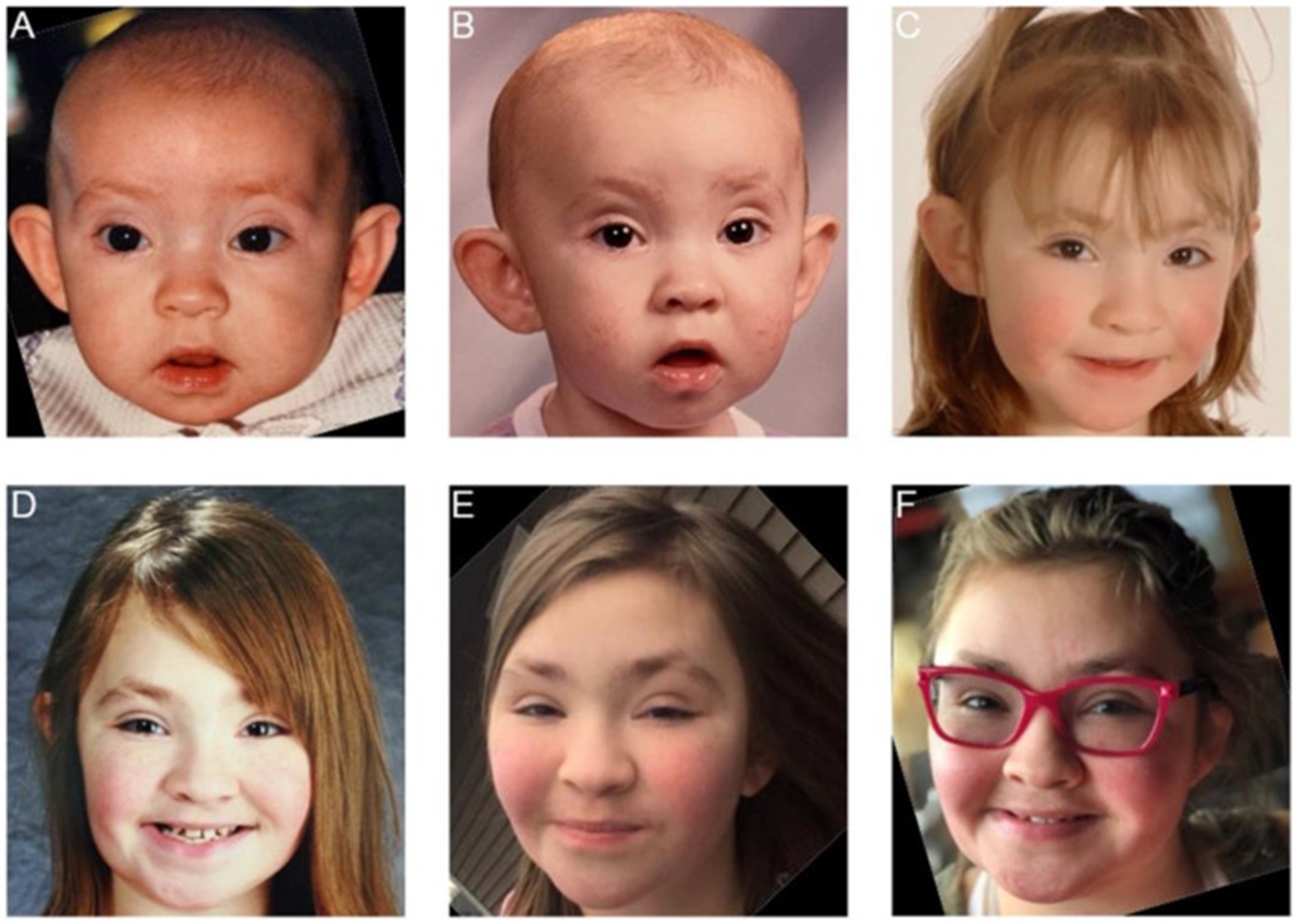 【佳学基因检测】歌舞伎化妆综合征基因检测Kabuki make-up syndrome