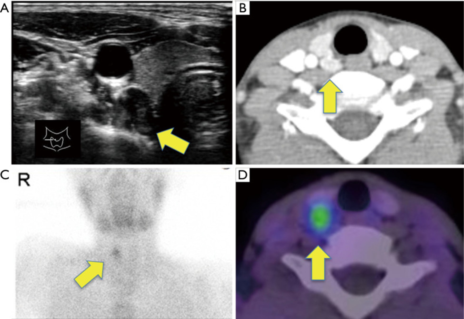 【佳学基因检测】原发性甲状旁腺功能亢进及钙代谢基因解码基因检测