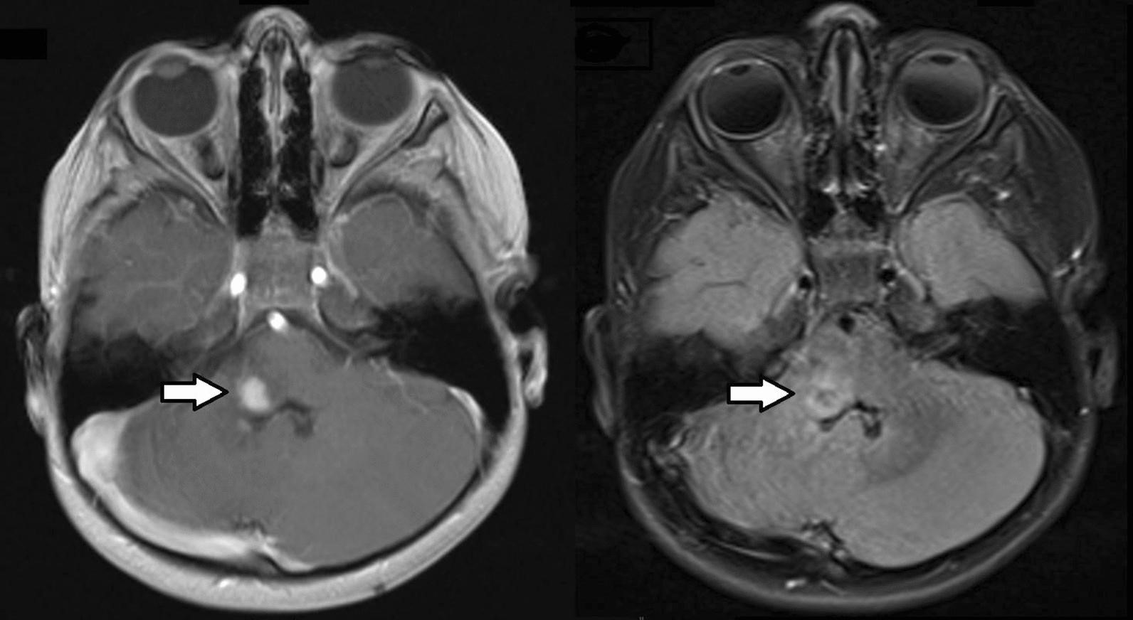 【佳学基因检测】脑干神经瘤NF2基因检测结果阴性是怎么找到致病基因突变的？ 