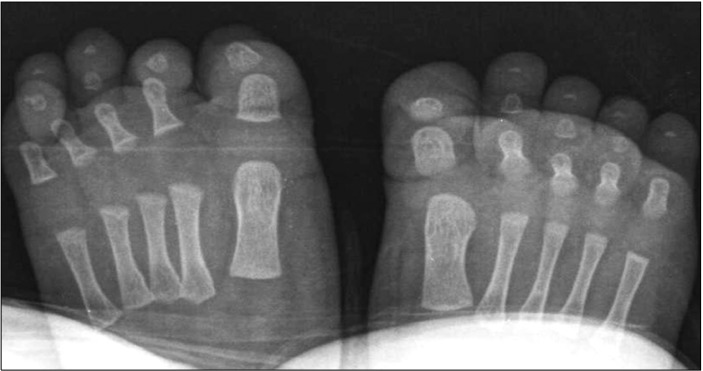【佳学基因检测】先天性第四脚趾趾甲的弯曲基因检测 【佳学基因检测】先天性第四脚趾趾甲的弯曲基因检测