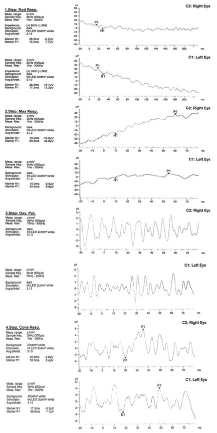 【佳学基因检测】巨额花费肾移植，却得了视网膜纤毛病：基因检测在肾病与眼科共病中的作用