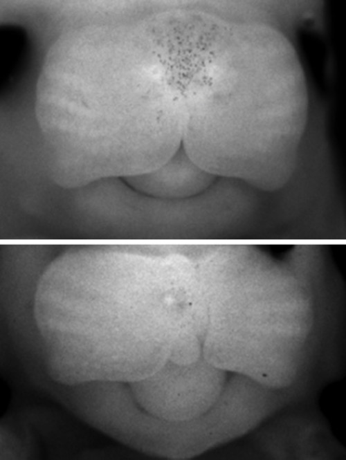 【佳学基因检测】唇裂、腭裂、唇腭裂遗传吗?如何阻断? 【佳学基因检测】唇裂、腭裂、唇腭裂遗传吗?如何阻断?