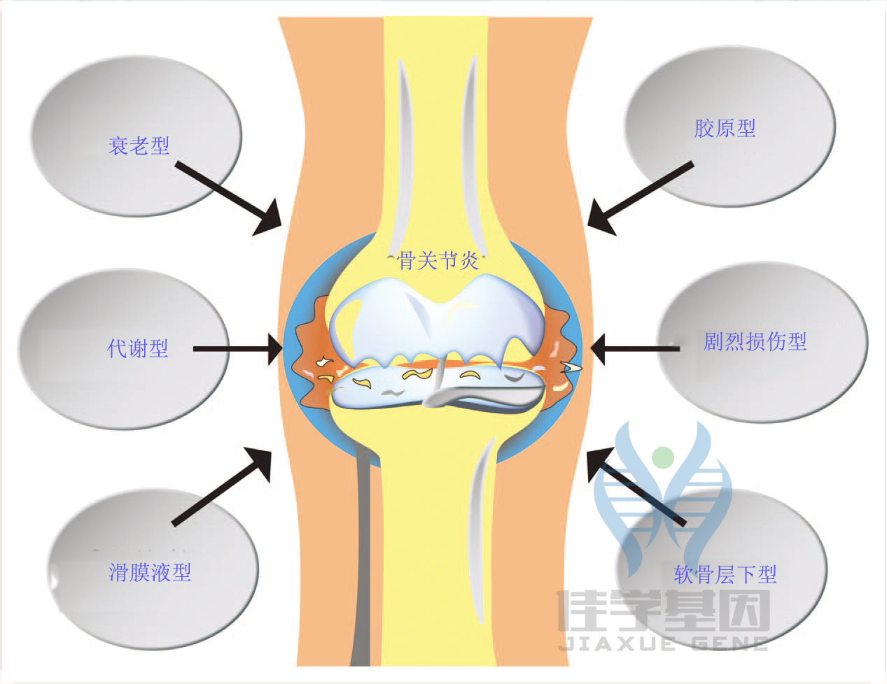 【佳学基因检测】骨关节炎基于基因检测的分子诊断分型 【佳学基因检测】骨关节炎基于基因检测的分子诊断分型