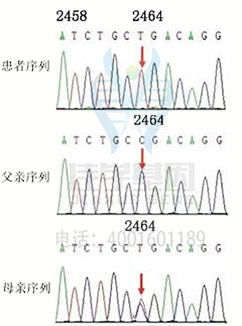【基因检测基因解码案例】洛伊综合征(LOWE SYNDROME)——佳学基因 【基因检测基因解码案例】洛伊综合征(LOWE SYNDROME)——佳学基因